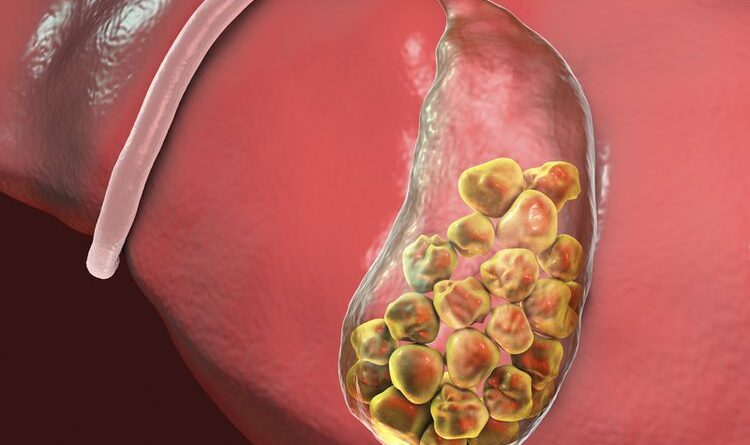 Batu Empedu: Gejala, Penyebab Dan Cara Menghilangkan