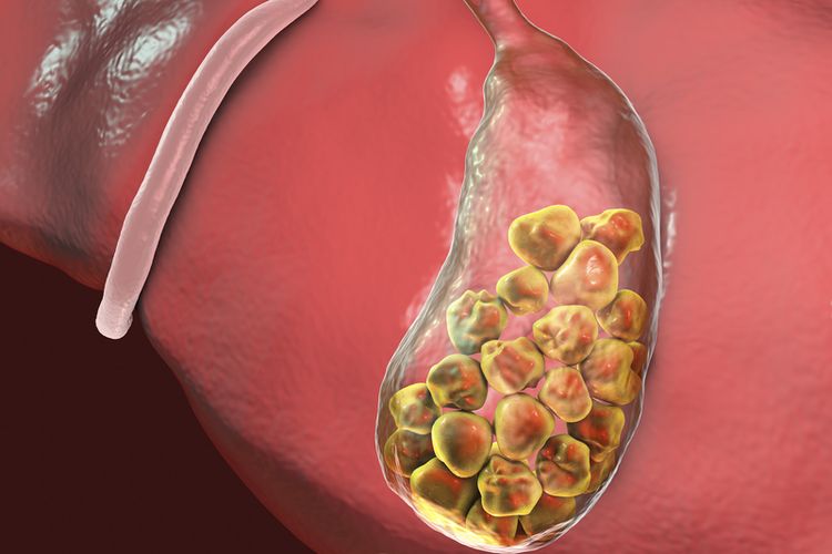 Batu Empedu: Gejala, Penyebab Dan Cara Menghilangkan