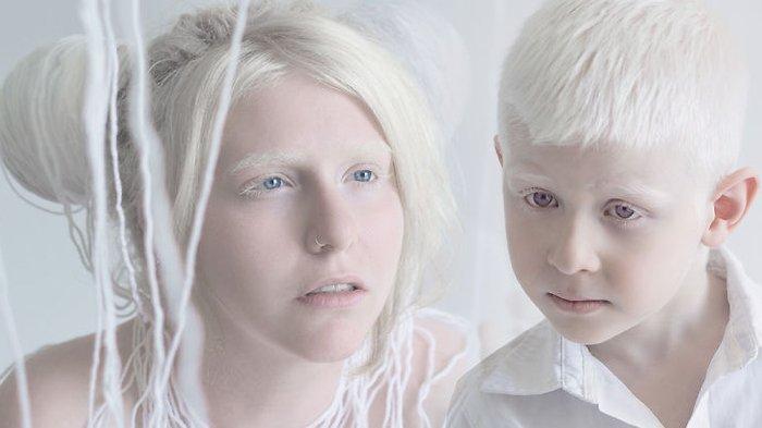 Albino Kelainan Genetik Menyebabkan Kekurangan Pigmen Melanin