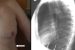 Paradoxical Chest Kondisi Medis Akibat Tulang Rusuk Patah