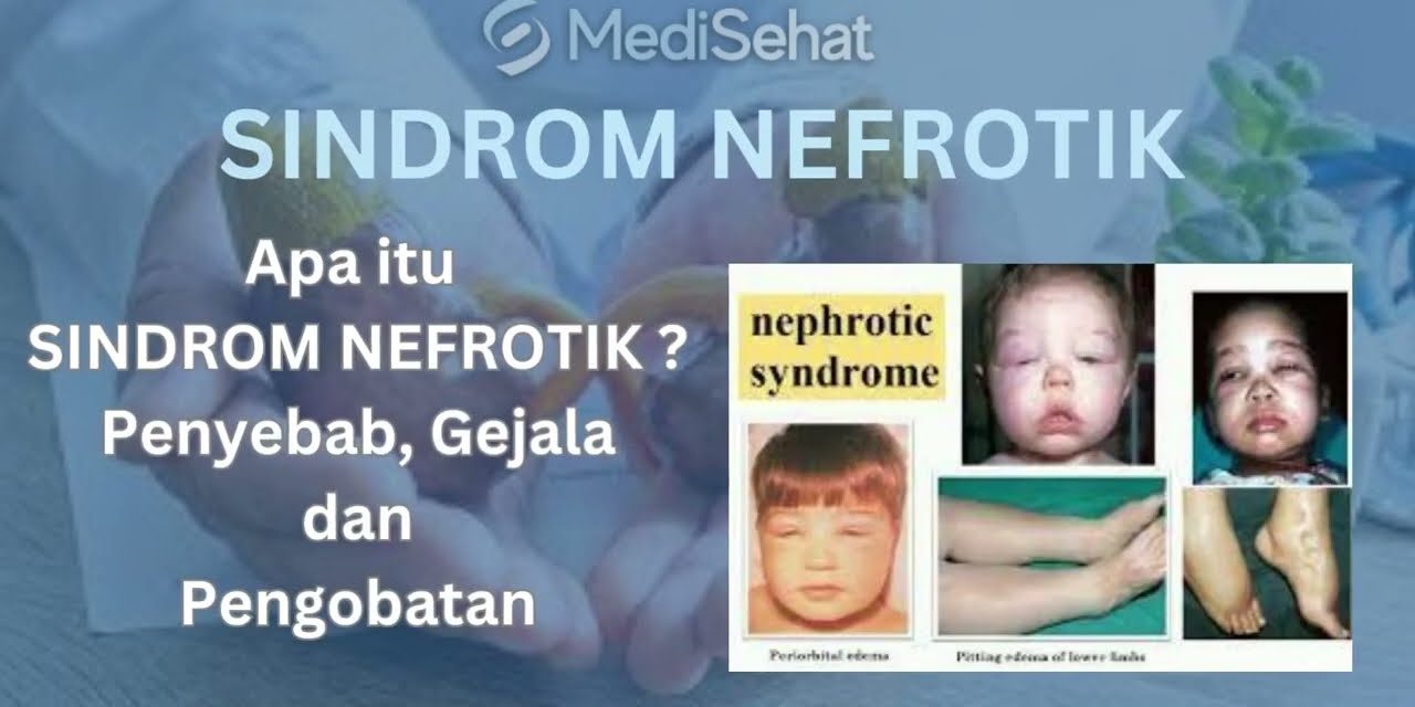 Mengenal Sindrom Nefrotik: Penyakit Ginjal Pada Anak-Anak