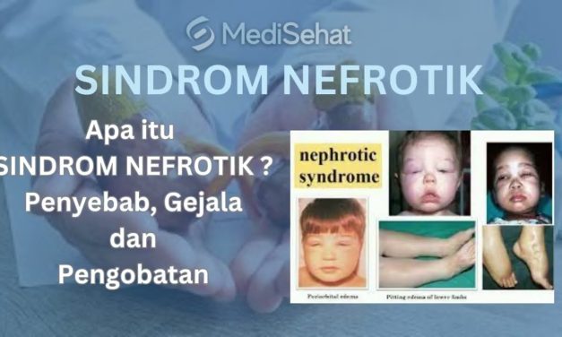 Mengenal Sindrom Nefrotik: Penyakit Ginjal Pada Anak-Anak