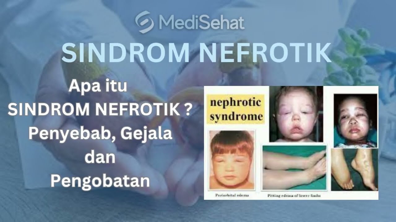 Mengenal Sindrom Nefrotik