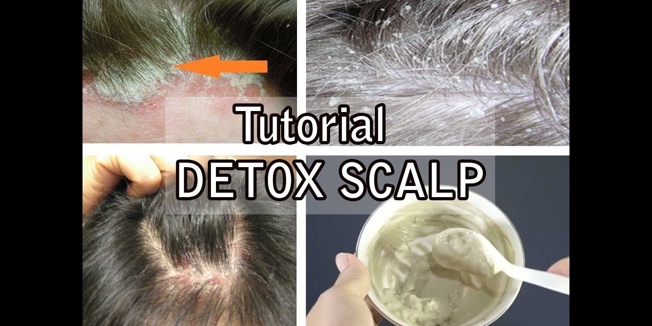 Perawatan Detox Ketombe Untuk Kulit Kepala Lebih Sehat