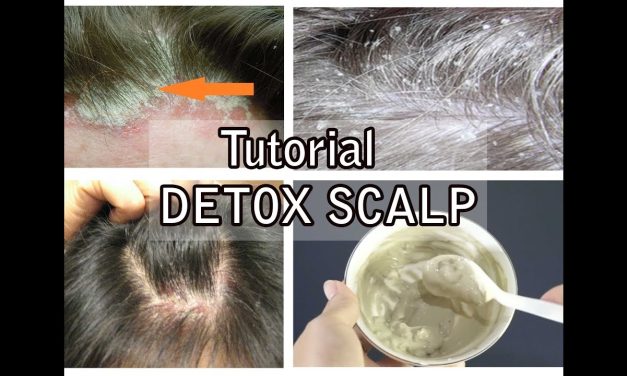 Perawatan Detox Ketombe Untuk Kulit Kepala Lebih Sehat