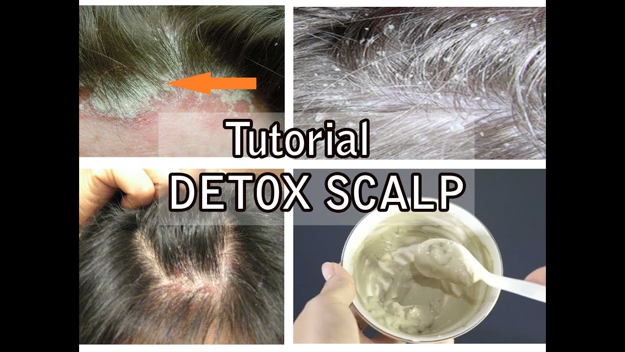 Perawatan Detox Ketombe