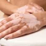 Penyakit Vitiligo Terjadi Karena Sel Pigmen Melanosit Rusak