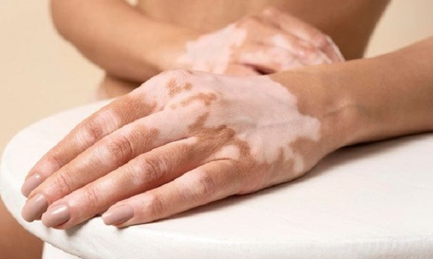 Penyakit Vitiligo Terjadi Karena Sel Pigmen Melanosit Rusak