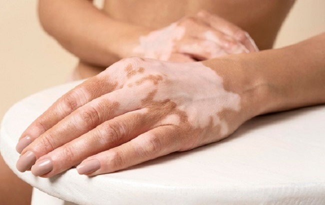 Penyakit Vitiligo Terjadi Karena Sel Pigmen Melanosit Rusak