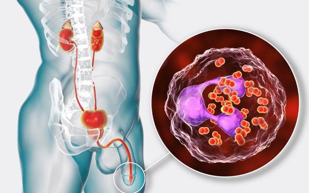 Penyakit Gonore Kenali Gejala, Penyebab Dan Pengobatannya