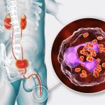 Penyakit Gonore Kenali Gejala, Penyebab Dan Pengobatannya