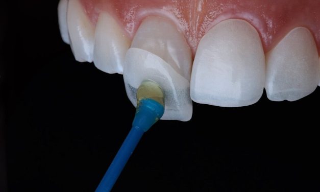 Veneer Gigi Bikin Tampilan Senyum Yang Cantik Serta Estetik